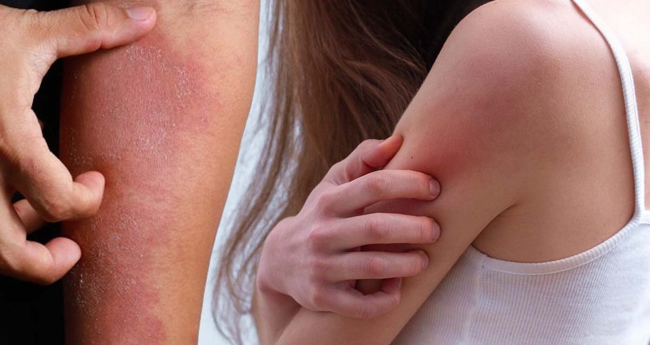 dermatoloji-uzmani-uyardi-kasinti-ve-kizariklik-varsajpg-ne_J7WeKOk6LiMv2XONI5g.jpg