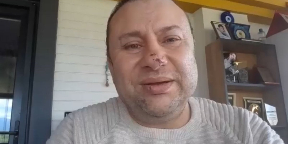 Pitbull Saldırısında Ölümden Dönen Onur Akay!