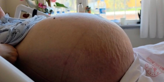 62 Yaşındaki Kadında 22 Kilogram Tümör!